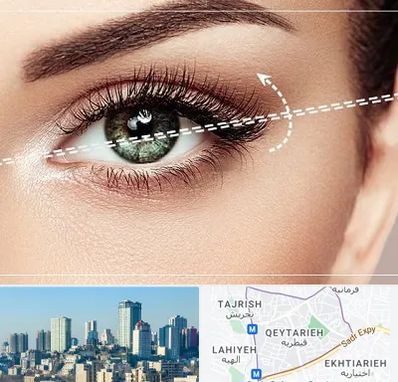 جراحی چشم گربه ای در قیطریه 