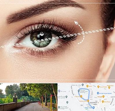 جراحی چشم گربه ای در بلوار گیلان رشت