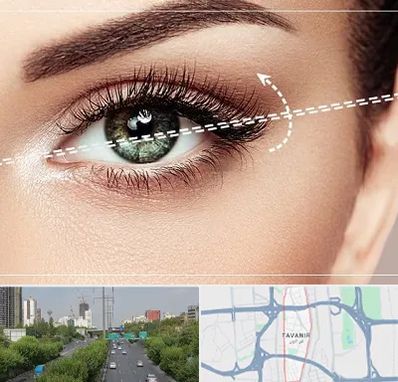 جراحی چشم گربه ای در توانیر