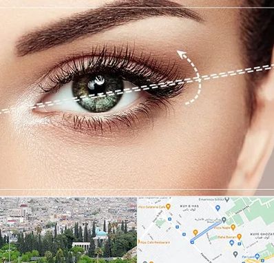 جراحی چشم گربه ای در محلاتی شیراز