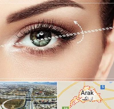 جراحی چشم گربه ای در اراک