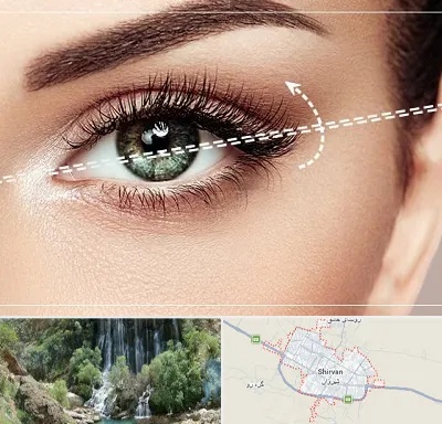 جراحی چشم گربه ای در شیروان