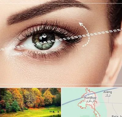 جراحی چشم گربه ای در کردکوی