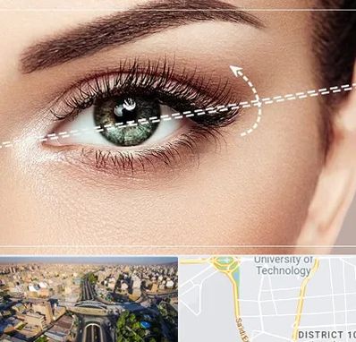 جراحی چشم گربه ای در استاد معین 