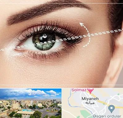 جراحی چشم گربه ای در میانه