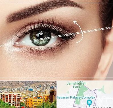 جراحی چشم گربه ای در نیاوران 