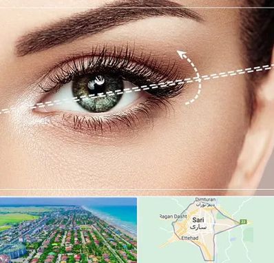 جراحی چشم گربه ای در ساری