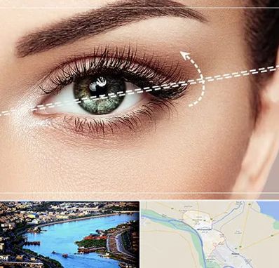 جراحی چشم گربه ای در خرمشهر