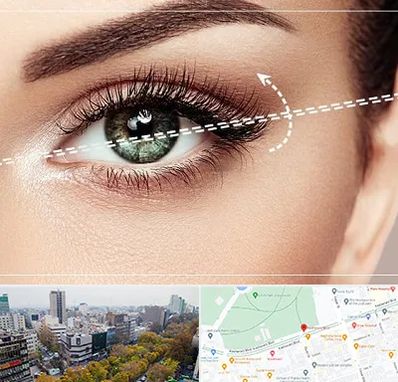جراحی چشم گربه ای در بلوار کشاورز 