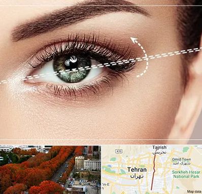 جراحی چشم گربه ای در ولیعصر 