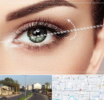 جراحی چشم گربه ای در ضیابری رشت