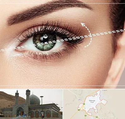 جراحی چشم گربه ای در شهرضا