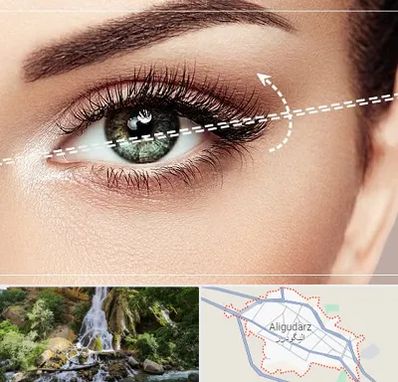 جراحی چشم گربه ای در الیگودرز