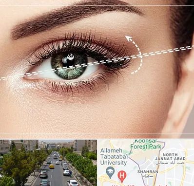 جراحی چشم گربه ای در شهران 