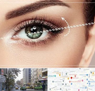 جراحی چشم گربه ای در فاطمی 