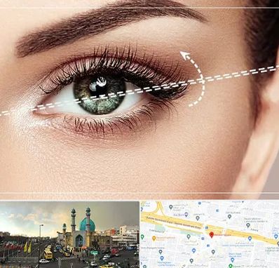 جراحی چشم گربه ای در رسالت 