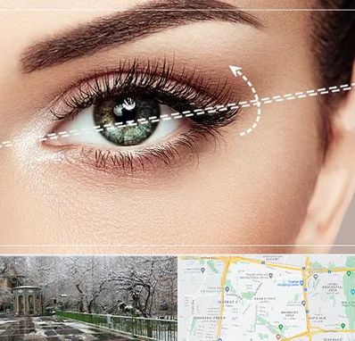 جراحی چشم گربه ای در باغ فیض