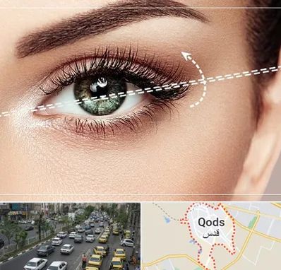 جراحی چشم گربه ای در شهر قدس