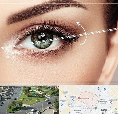 جراحی چشم گربه ای در شاهین ویلا کرج