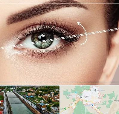 جراحی چشم گربه ای در مراغه