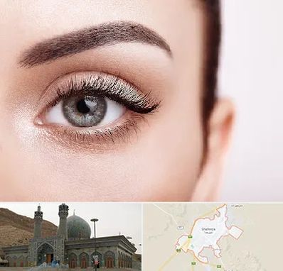 فوق تخصص عنبیه در شهرضا