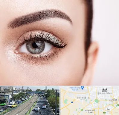 فوق تخصص عنبیه در جنوب تهران 