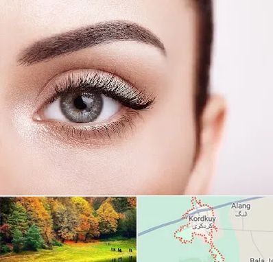 فوق تخصص عنبیه در کردکوی