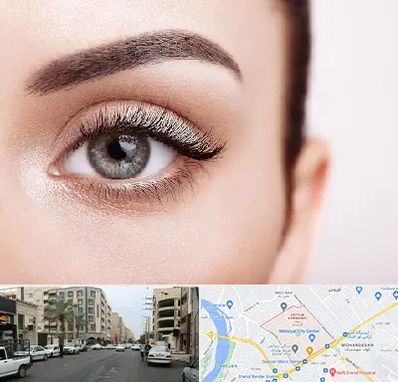 فوق تخصص عنبیه در زیتون کارمندی اهواز