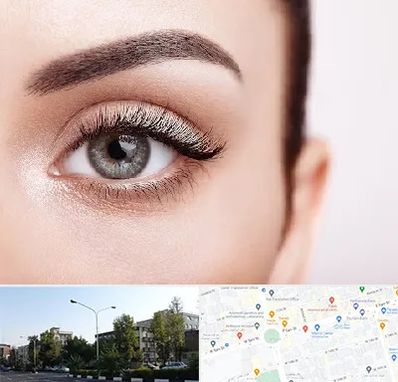 فوق تخصص عنبیه در میدان کاج 