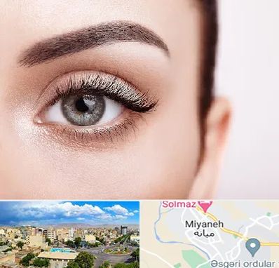 فوق تخصص عنبیه در میانه