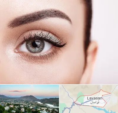 فوق تخصص عنبیه در لواسان