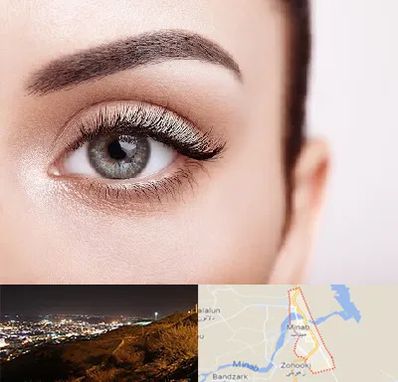 فوق تخصص عنبیه در میناب