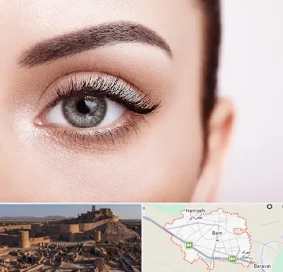 فوق تخصص عنبیه در بم
