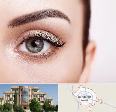 فوق تخصص عنبیه در دهدشت