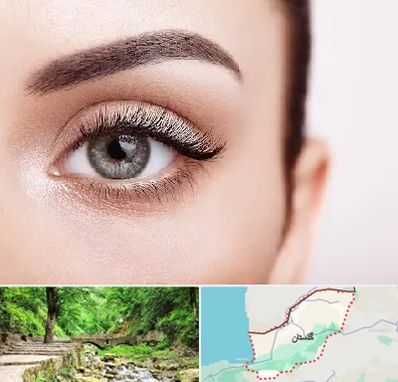 فوق تخصص عنبیه در گلستان