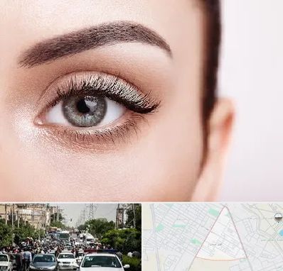 فوق تخصص عنبیه در سیدی مشهد