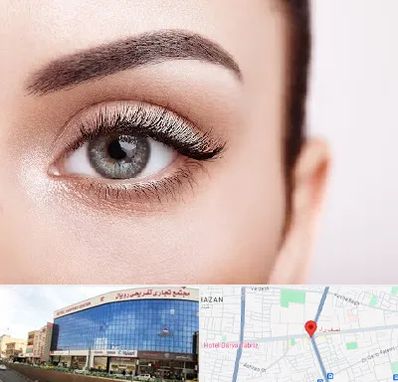 فوق تخصص عنبیه در نصف راه تبریز