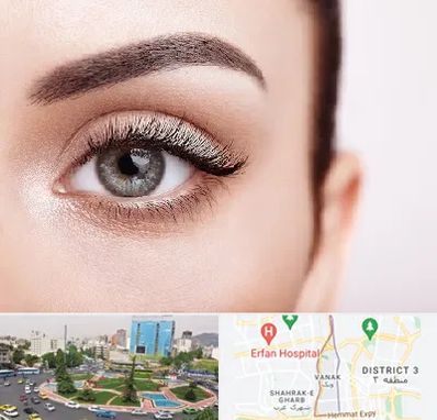 فوق تخصص عنبیه در ونک 