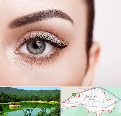 فوق تخصص عنبیه در بهشهر