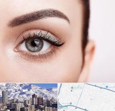 فوق تخصص عنبیه در ازگل