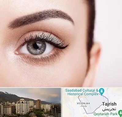 فوق تخصص عنبیه در زعفرانیه 