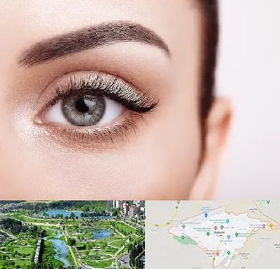 فوق تخصص عنبیه در بجنورد