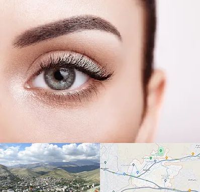 فوق تخصص عنبیه در رودهن