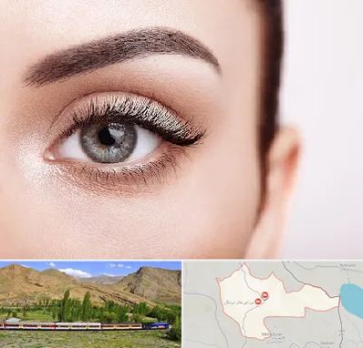 فوق تخصص عنبیه در خاش