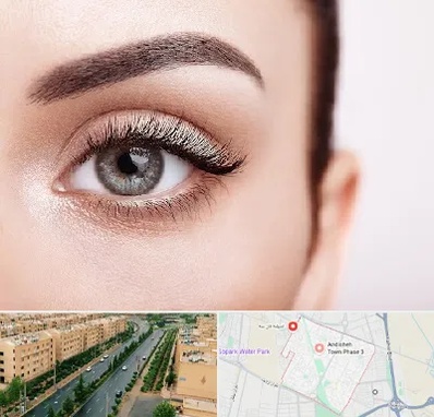 فوق تخصص عنبیه در فاز سه اندیشه