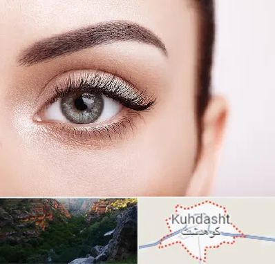 فوق تخصص عنبیه در کوهدشت