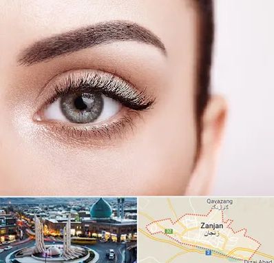 فوق تخصص عنبیه در زنجان