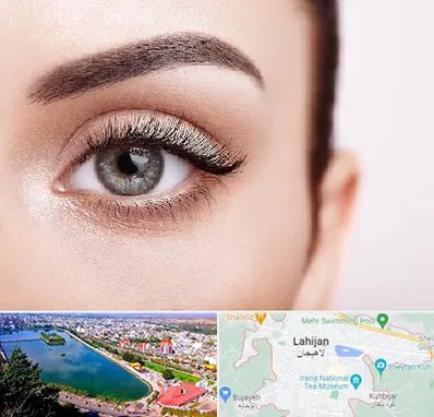 فوق تخصص عنبیه در لاهیجان