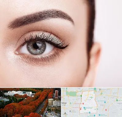 فوق تخصص عنبیه در منطقه 6 تهران 