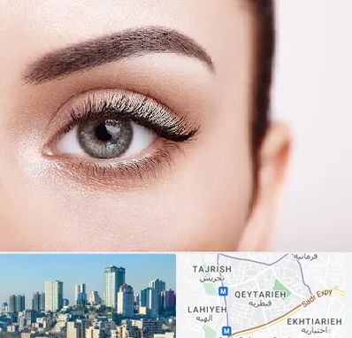 فوق تخصص عنبیه در قیطریه 